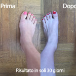alluce-valgo-prima-dopo